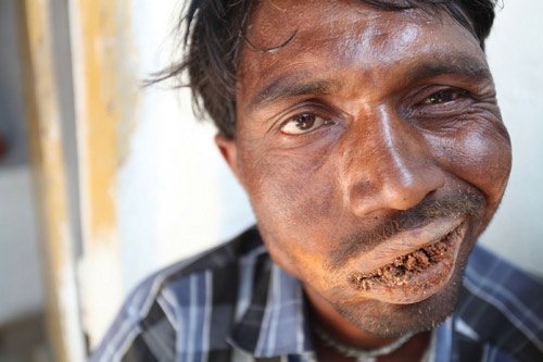 Hundagundi bị mắc hội chứng Pica 