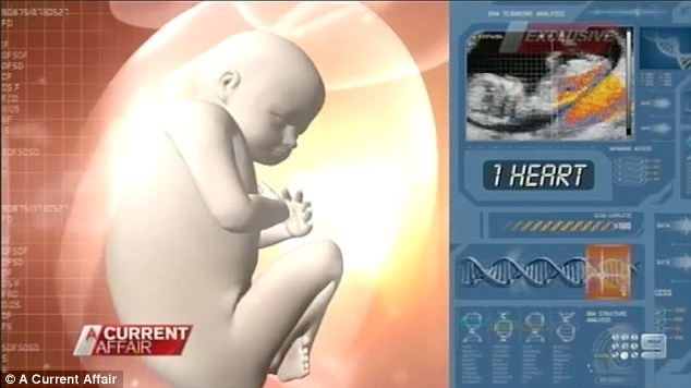 Hình ảnh siêu âm cặp song sinh dính liền mặt. Ảnh: