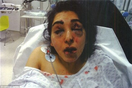 Dam vao mat con dau vi nghi ngo ngoai tinh hinh anh