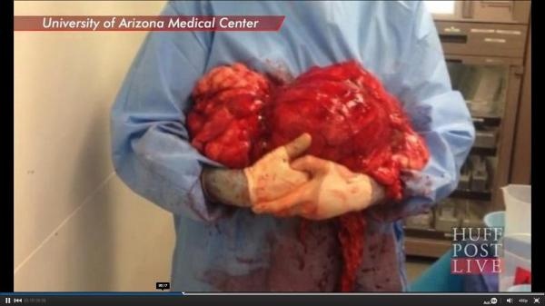 Khoi u hon 20 kg trong bung mot phu nu My hinh anh