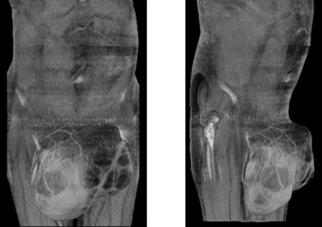 Bác sĩ chuẩn đoán ông mắc bệnh sarcoma, một loại ung thư hiếm gặp của các mô, cơ và xương. Ảnh: Dailymail.
