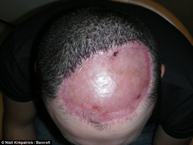 Tại Anh, các bác sĩ đã cắt bỏ 23 cm da đầu của Chris và dùng da đùi tái tạo lại chỗ da đầu đã mất khiến chúng không thể mọc tóc. Ảnh: Dailymail.