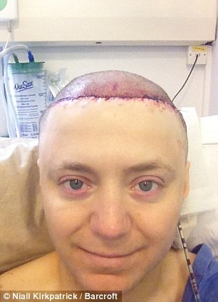 Da đầu của Stoyanov bắt đầu mọc tóc trở lại. Ảnh: Dailymail.