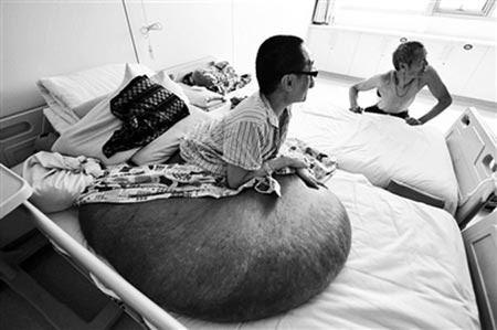 Nguoi dan ong co khoi u hon 200kg hinh anh