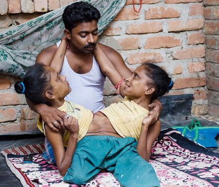 Chuyen tinh cua cap song sinh dinh lien cung yeu mot nguoi hinh anh