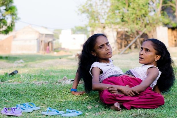 Cặp song sinh dính liền Ganga và Jamuna Mondal yêu cùng một người đàn ông. Ảnh: Miror