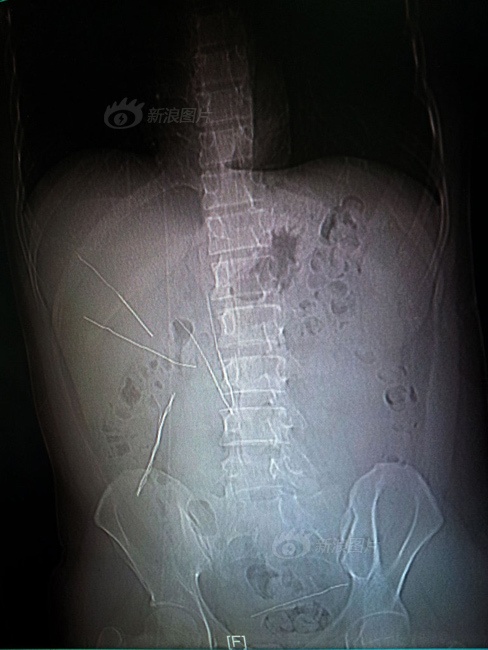 Gian vo, nam thanh nien nuot 8 day thep hinh anh