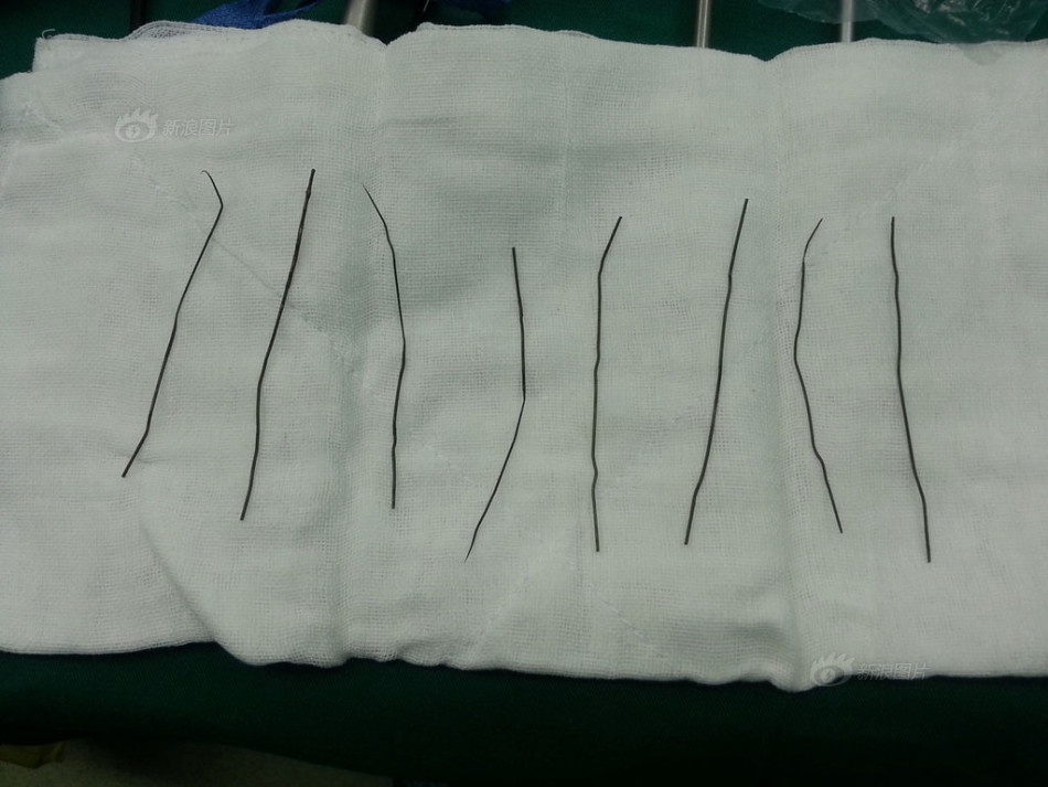 Các bác sỹ đã lấy toàn bộ số dây thép nằm nửa năm trong bụng bệnh nhân. Ảnh: Sina