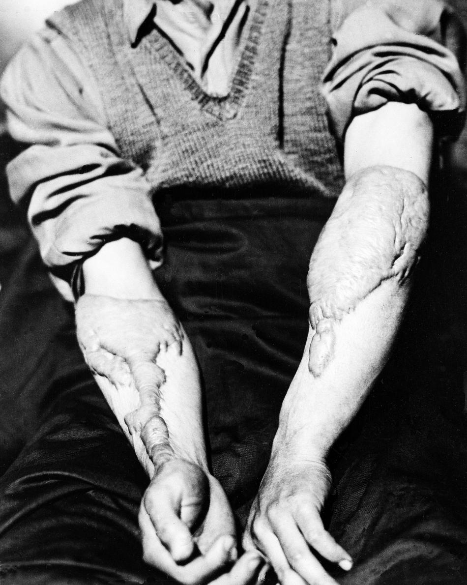 Anh Akira Yamaguchi, công dân Hiroshima, mang trên người những vết sẹo do bỏng. Vai trò của hai vụ nổ đối với việc nước Nhật đầu hàng, cũng như hậu quả và các giải thích cho việc thả bom vẫn là chủ đề còn bàn cãi.