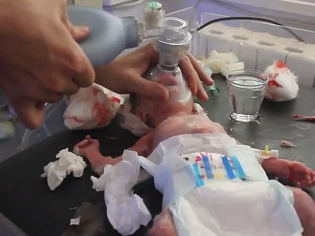 Be so sinh thoat chet du trung dan xuyen bung me hinh anh