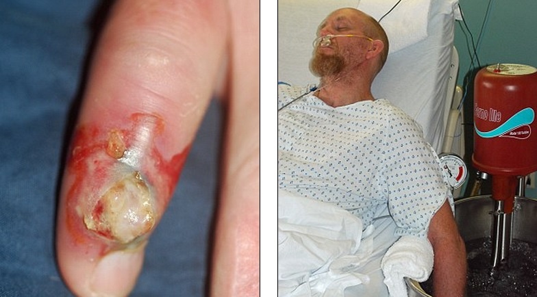 Trong hàng chục năm hành nghề, loài rắn đã 8 lần cắn vào tay ông Harrison. Thậm chí có lần ông phải nhập viện đến 4 tuần để điều trị vết thương vì rắn cắn. Các bác sĩ đã phẫu thuật để cắt bỏ những phần nhiễm trùng nặng trên ngón tay của ông Harrison. 