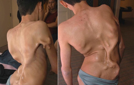 Cơ thể người mắc hội chứng người hóa đá (FOP).  Ảnh minh họa: Tumblr.com