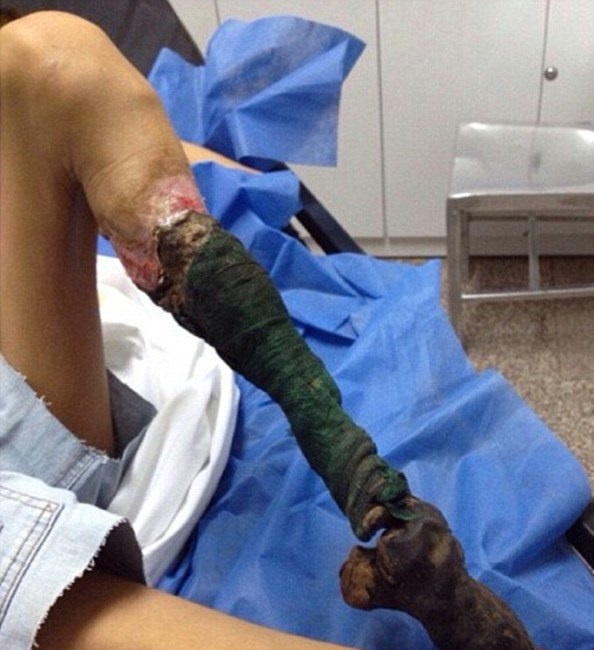 Chan hoai tu va bien dang vi ran can hinh anh