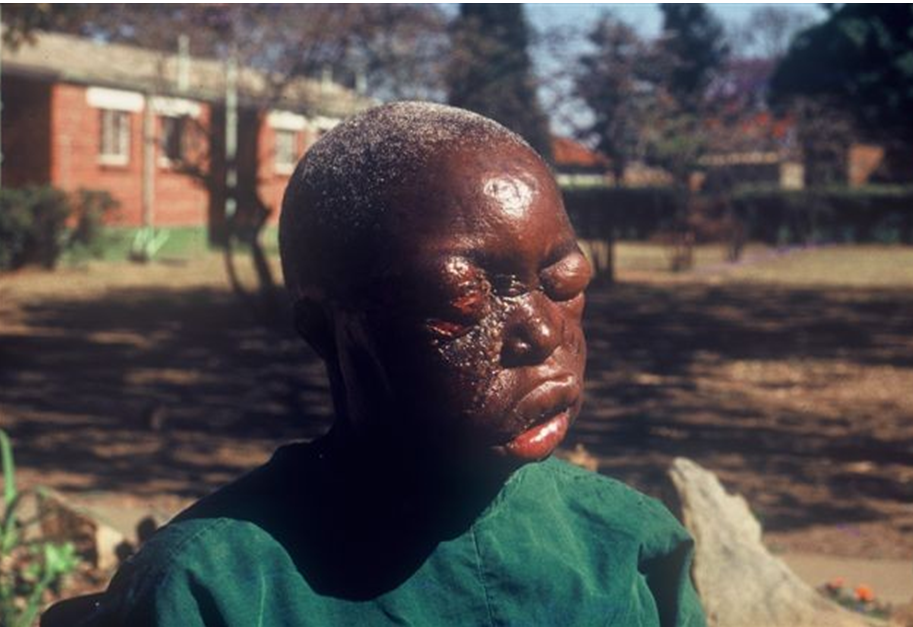 Trong khi đó, theo số liệu ngày 19/11 từ WHO, số người tử vong do đại dịch Ebola đã tăng lên 5.420 người và 14.413 trường hợp nhiễm bệnh tại 8 quốc gia. Đây được coi là dịch Ebola nghiêm trọng nhất trong 4 thập kỷ qua.