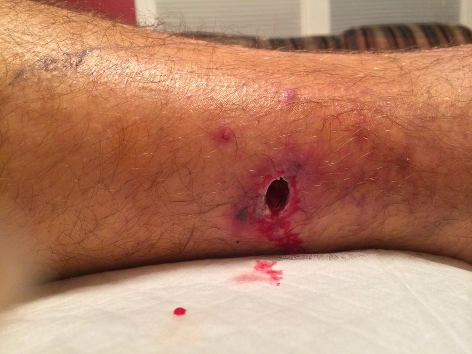 Vết rắn cắn ở chân của anh Dana. Ảnh: Out360
