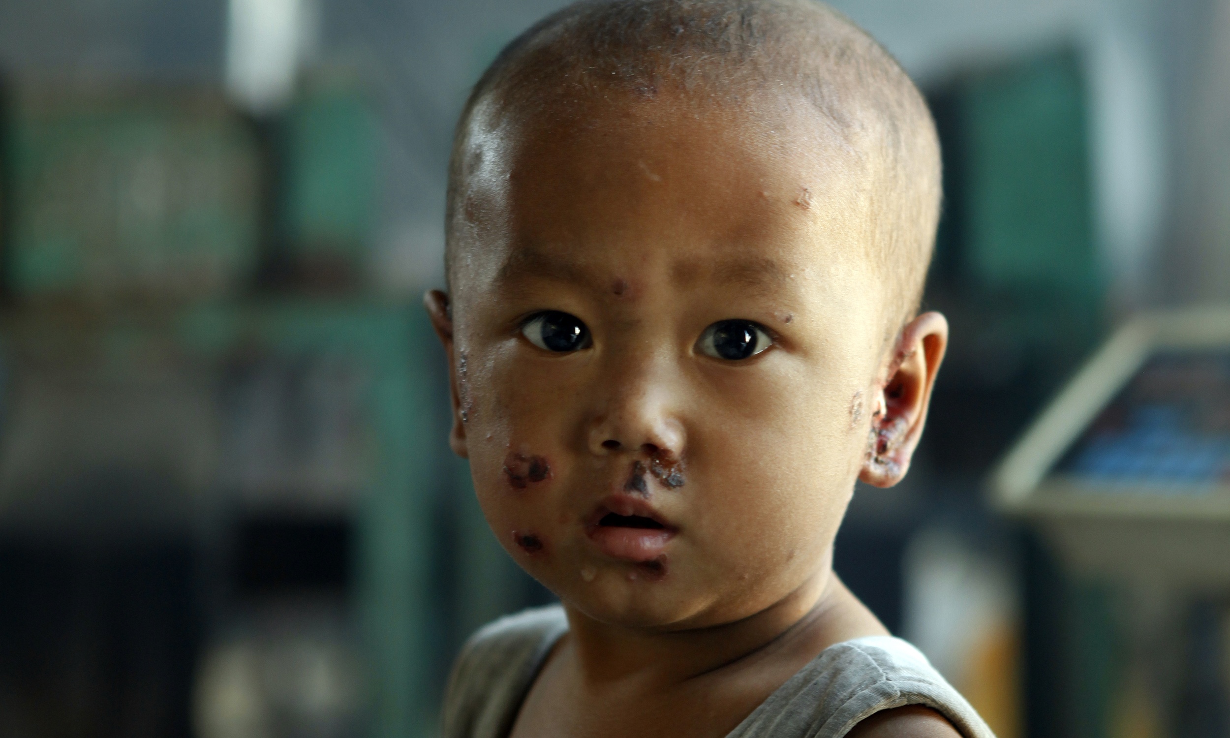 Một em bé bị bệnh chốc lở trên da. Đây không phải là bệnh hiếm đối với trẻ em và công nhân ở những xưởng xử lý rác, do họ hàng ngày phải đối mặt với khí độc và rác thải nhiễm bẩn. Tại những ngôi làng này, tỉ lệ người bị ung thư cũng cao hơn những địa phương khác.