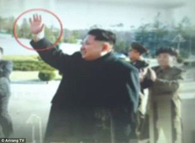 Ong Kim Jong Un  bi chan thuong co tay hinh anh