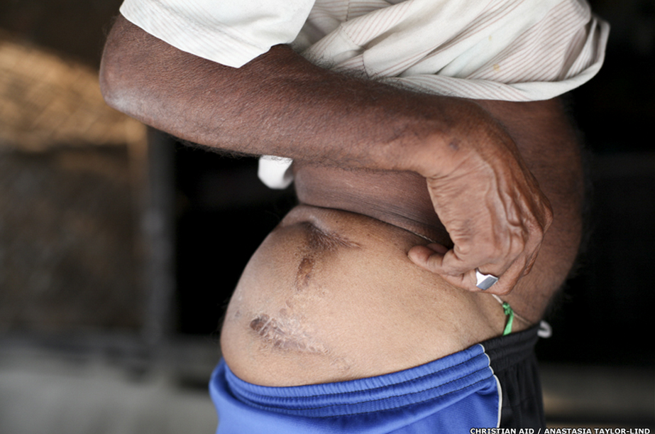 Hổ tấn côngRanjit Biswas khi anh đang đốn gỗ trong rừng. “Nó đột nhiên xuất hiện sau lưng và cắn vào hông, khiến tôi ngã xuống đất. Con vật cấu xé tôi trong 10 phút”.