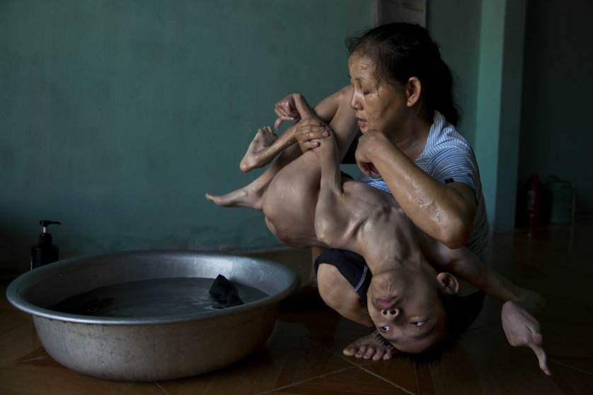 Tran Thien Nhan, with severely malformed head and diminutive body, is an Agent Orange victim in Danang, Vietnam. His mother, Ngo Thi Tinh, and grandmother, The Thi Dao, care for him. 