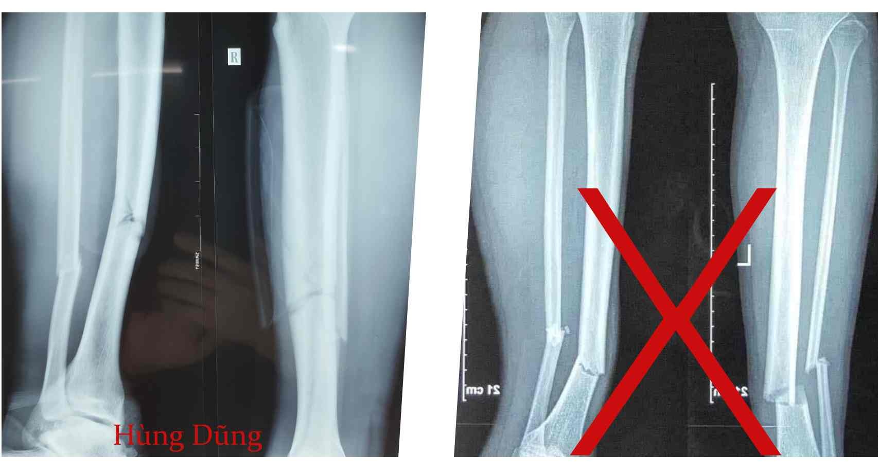 hung dung gay chan anh 1