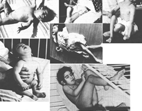 Nhiễm độc thủy ngân ở Nhật Bản ảnh 3 Nhiem doc thuy ngan o Nhat Ban anh 3