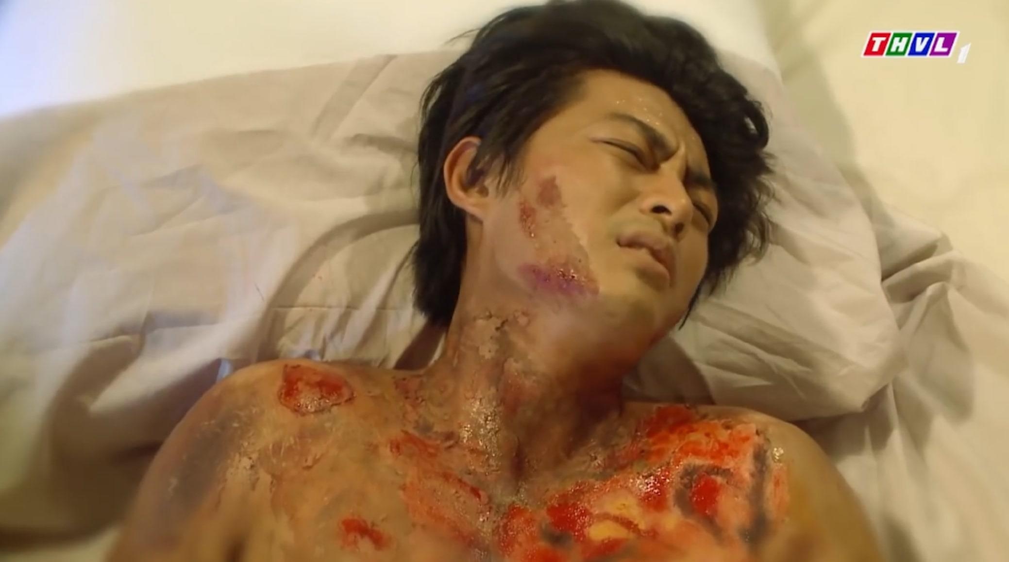 Thanh Binh bi bong nang, Khai Duy khong cho con di chua tri hinh anh