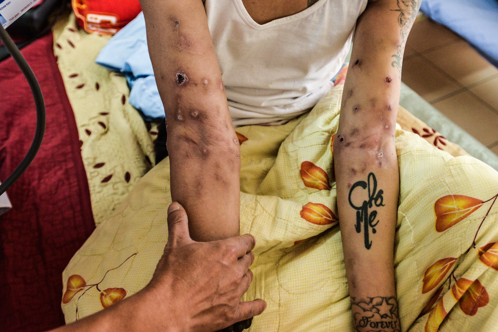 bệnh nhân nhiễm HIV ảnh 24 benh nhan nhiem HIV anh 24