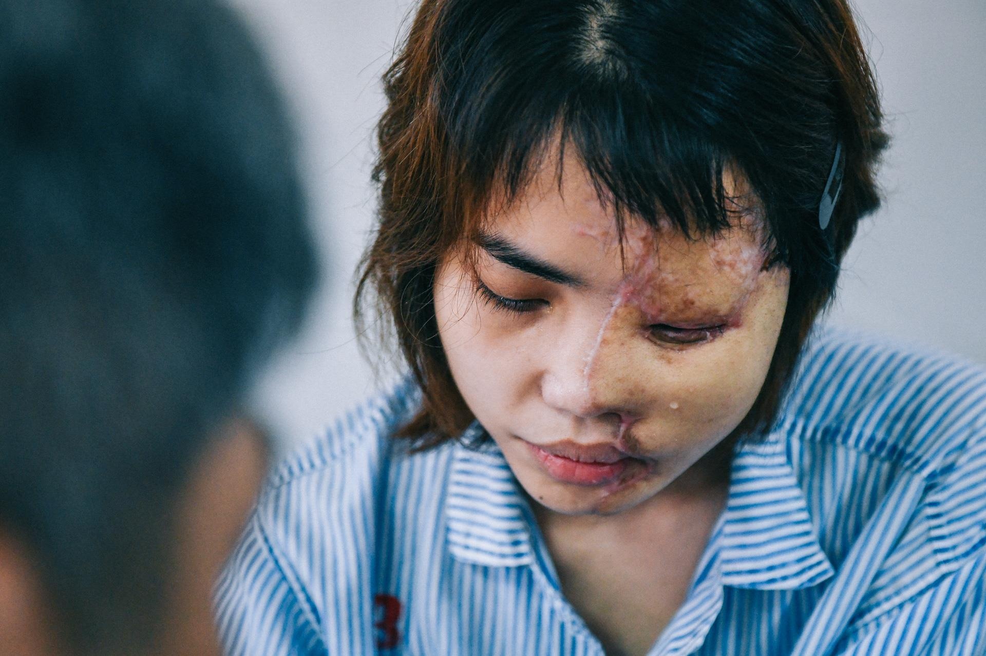 Nan nhan bi tat axit anh 6