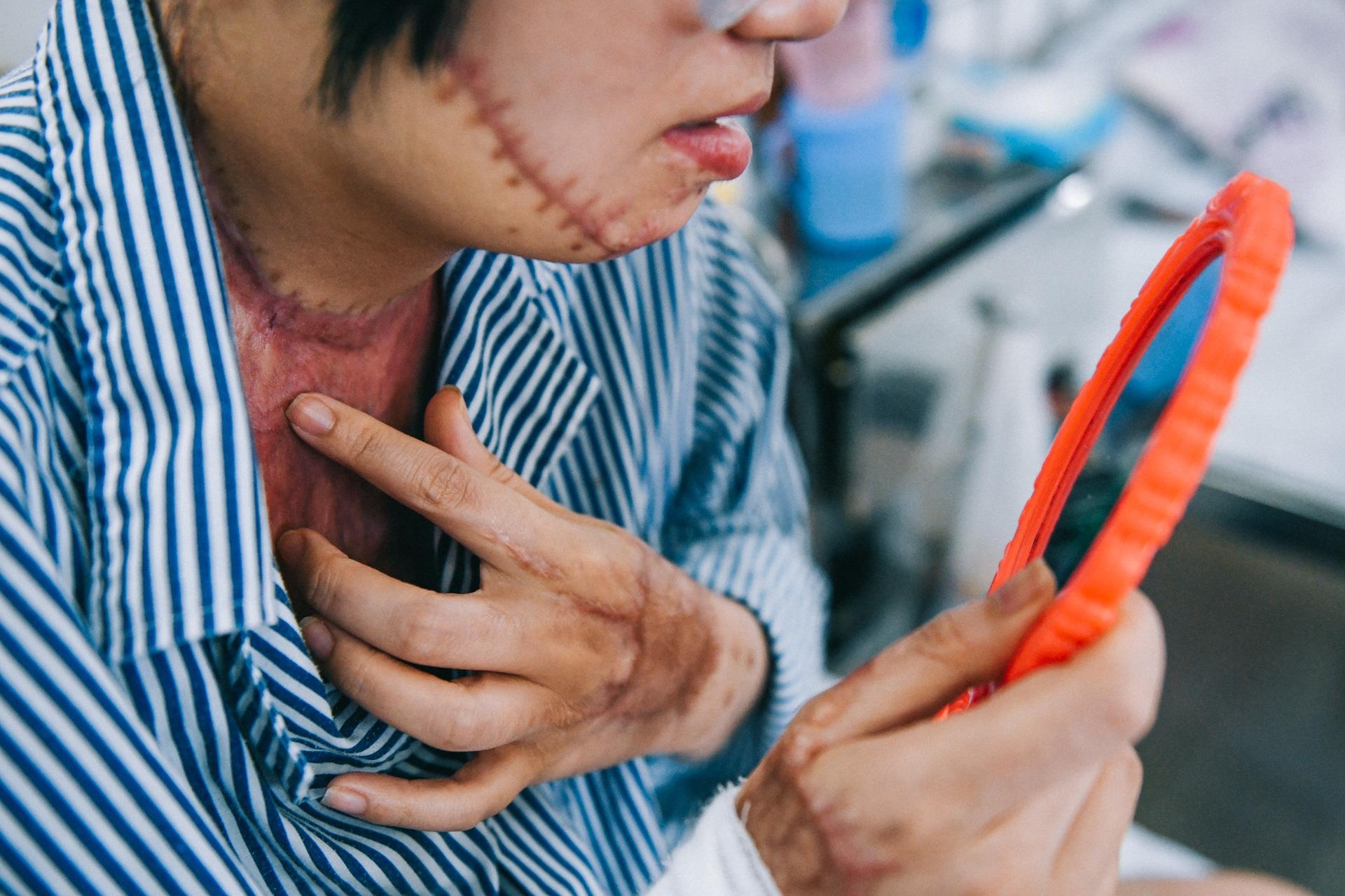 Nan nhan bi tat axit anh 2