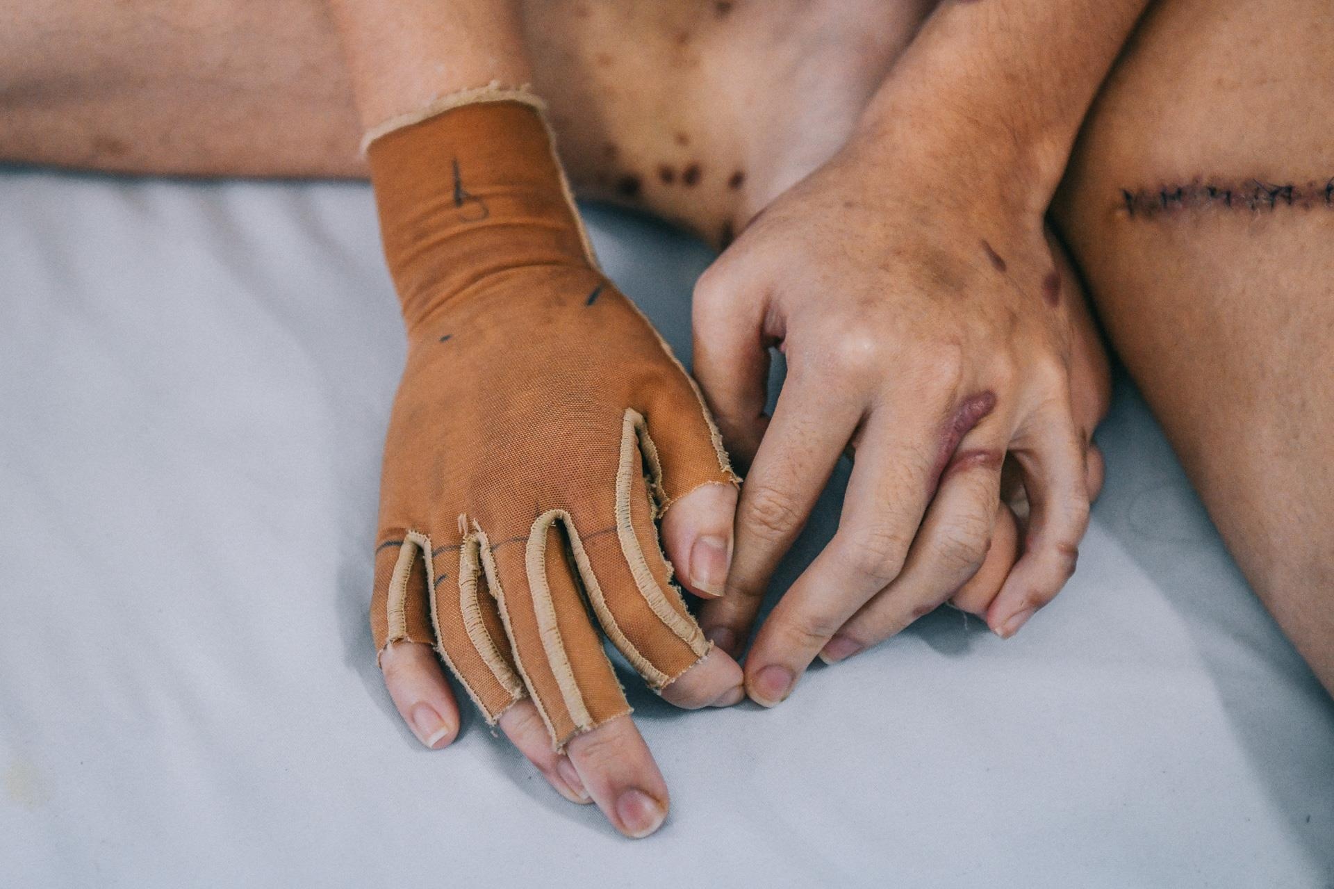 Nan nhan bi tat axit anh 4