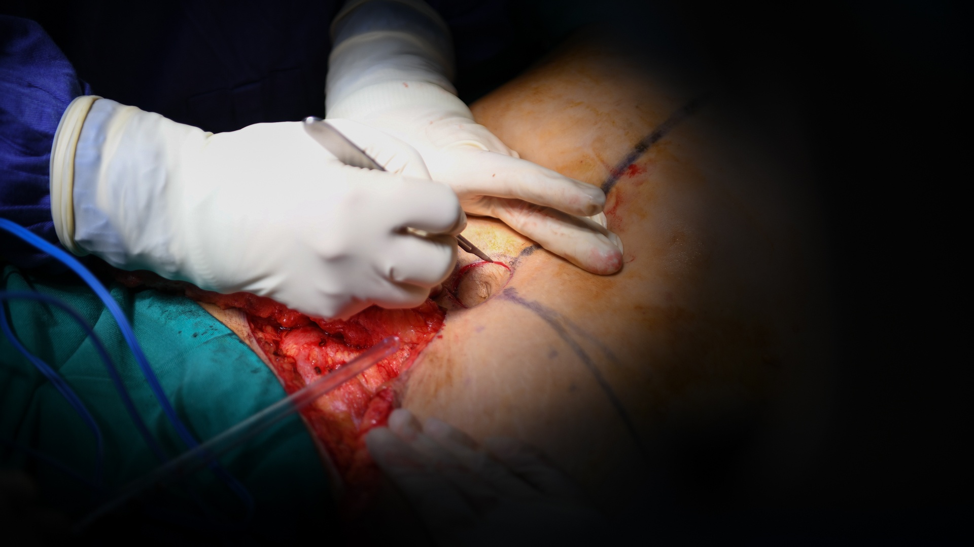 tạo hình thành bụng ảnh 11 tao hinh thanh bung anh 11