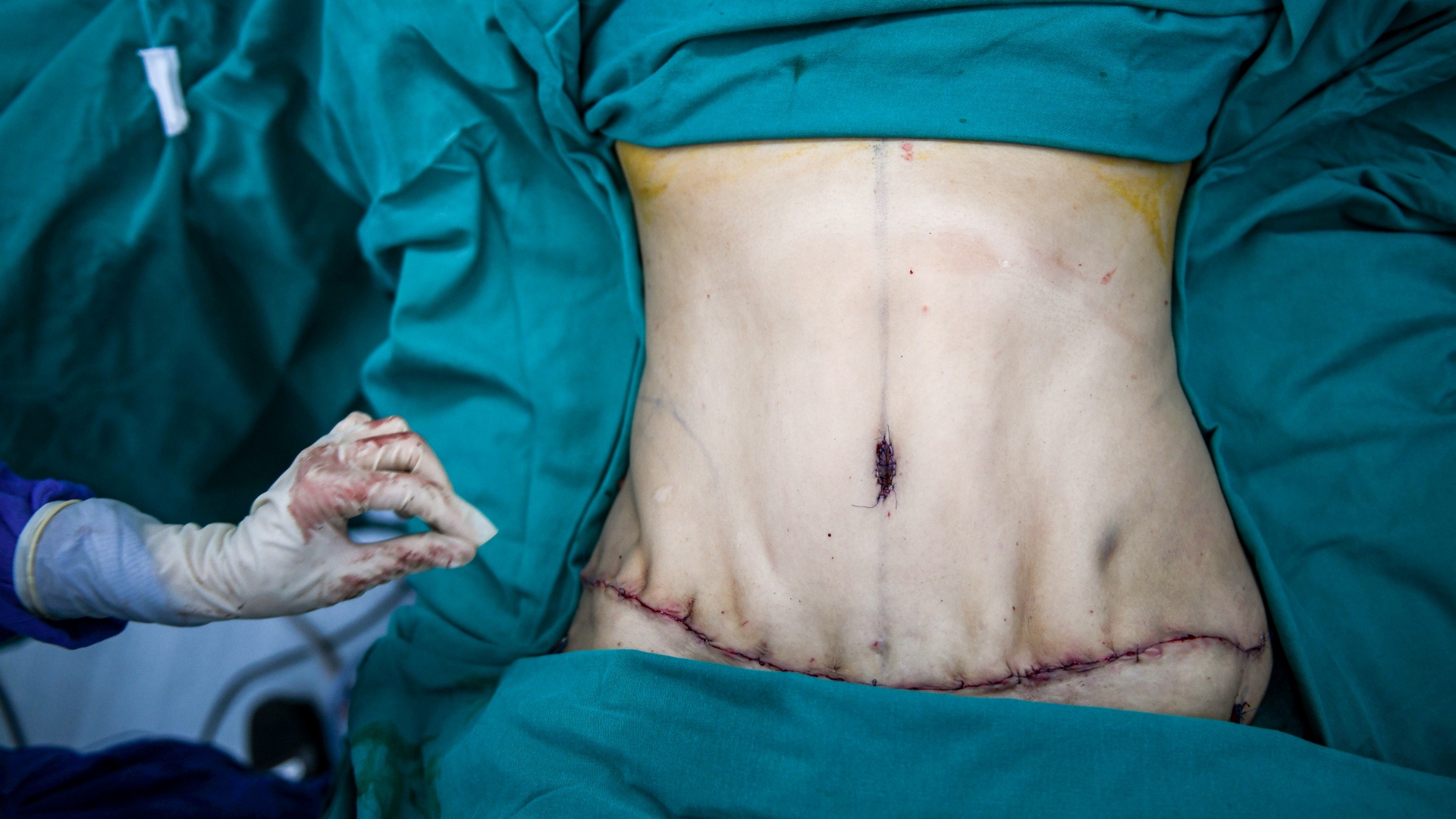 tạo hình thành bụng ảnh 17 tao hinh thanh bung anh 17