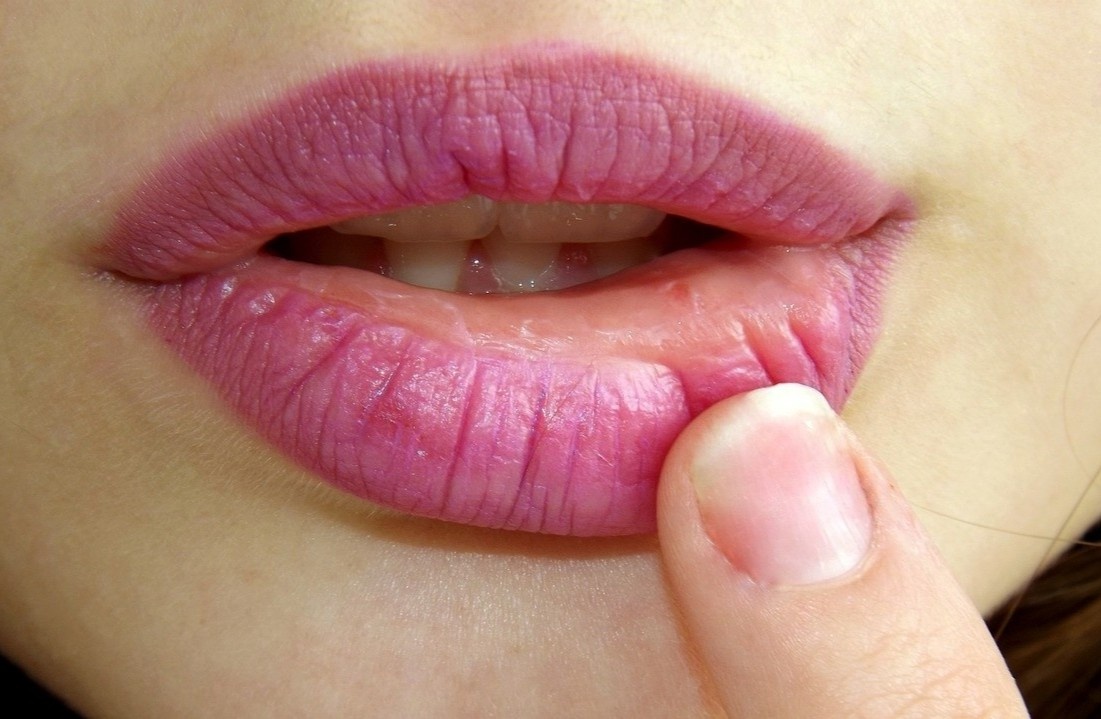 Nhap vien vi kich ung sau khi dung son gia re hinh anh