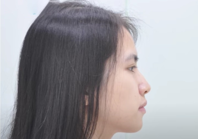 Video 'Nieng rang dep - Dr.Vuong' hinh anh