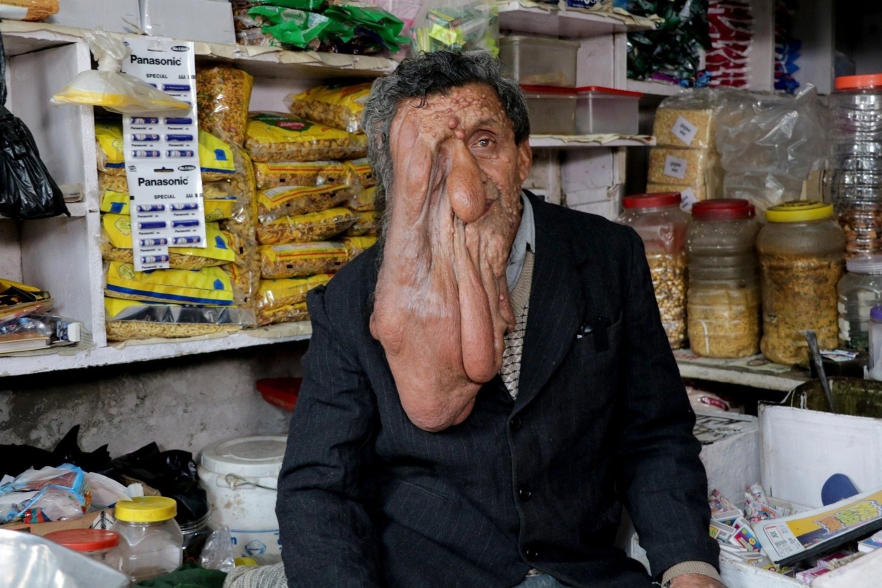 Can benh hiem gap khien nguoi dan ong mang 'khuon mat quy' hinh anh