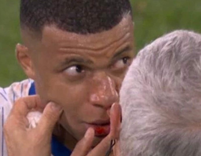 Mbappe chan thuong anh 1