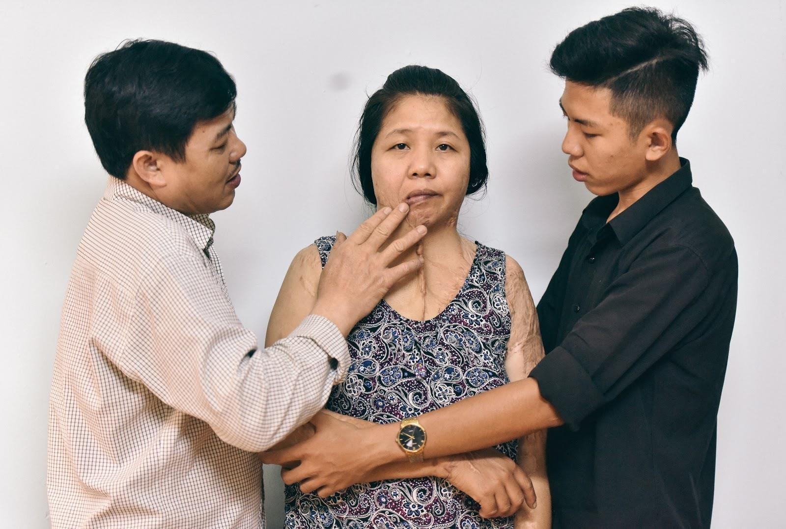 Vet seo axit, noi dau khong loi va tinh yeu luc doi tam toi hinh anh