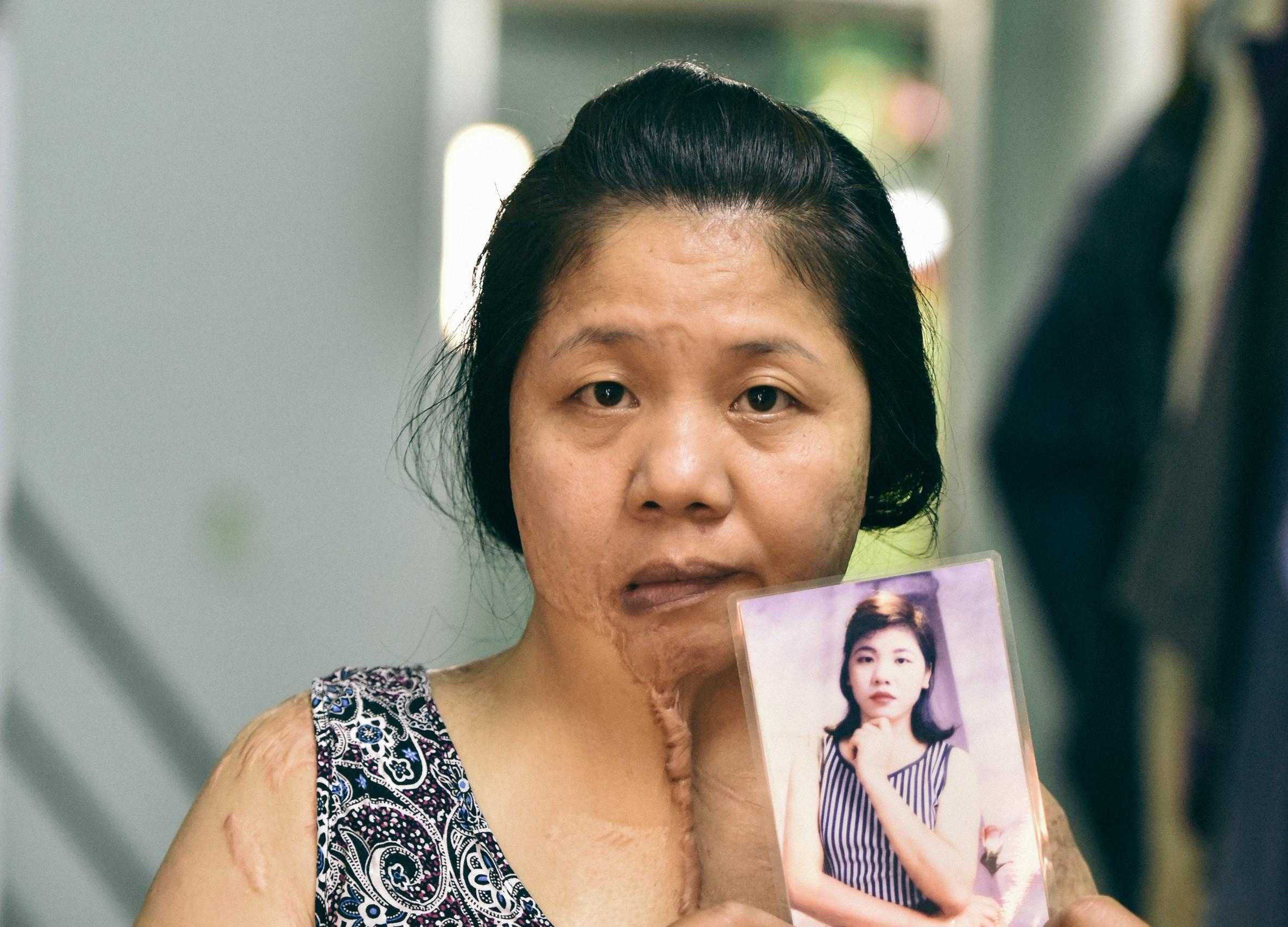 Uan khuc trong vu nguoi phu nu bi tat axit 5 nam khong tim ra hung thu hinh anh