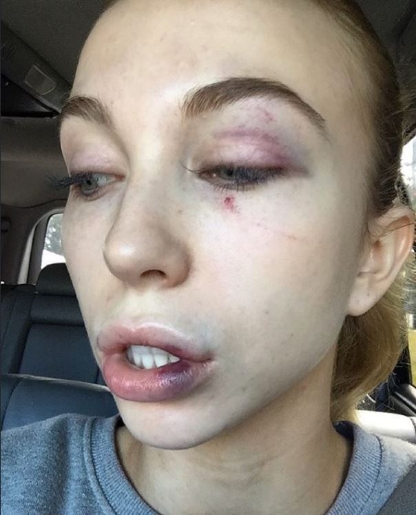 Thí sinh Hoa hậu Hoàn vũ bị đánh ảnh 1 Thi sinh Hoa hau Hoan vu bi danh anh 1