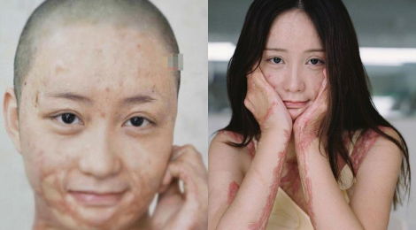 Nguoi mau teen tung bi thieu song vi tinh lo dien sau 5 nam hinh anh