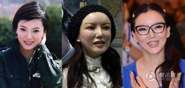 Hau qua sao Hoa ngu khi botox qua da anh 6