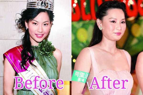 Hau qua sao Hoa ngu khi botox qua da anh 7