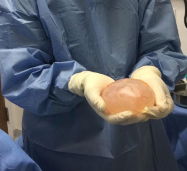 Karen McDougal phẫu thuật bỏ miếng độn ngực ảnh 3 Karen McDougal phau thuat bo mieng don nguc anh 3