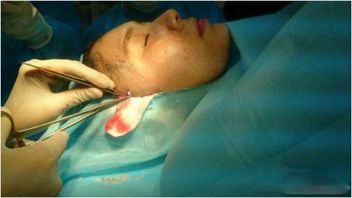 Thanh Bi phẫu thuật thẩm mỹ ảnh 2 Thanh Bi phau thuat tham my anh 2