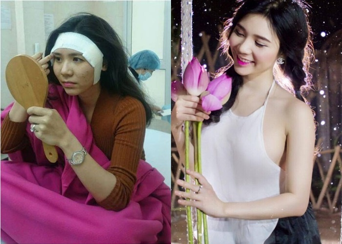 Thanh Bi phẫu thuật thẩm mỹ ảnh 3 Thanh Bi phau thuat tham my anh 3