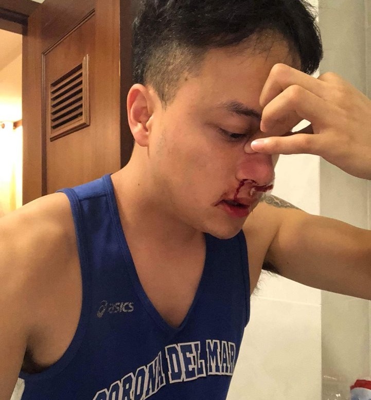 Cao Thái Sơn chảy máu mũi suốt nửa đêm ảnh 1 Cao Thai Son chay mau mui suot nua dem anh 1