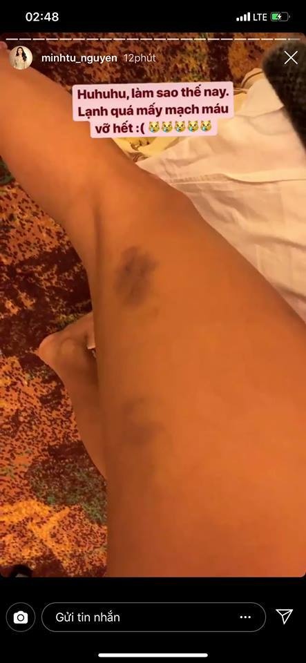 Minh Tú vỡ mao mạch máu ảnh 2 Minh Tu vo mao mach mau anh 2