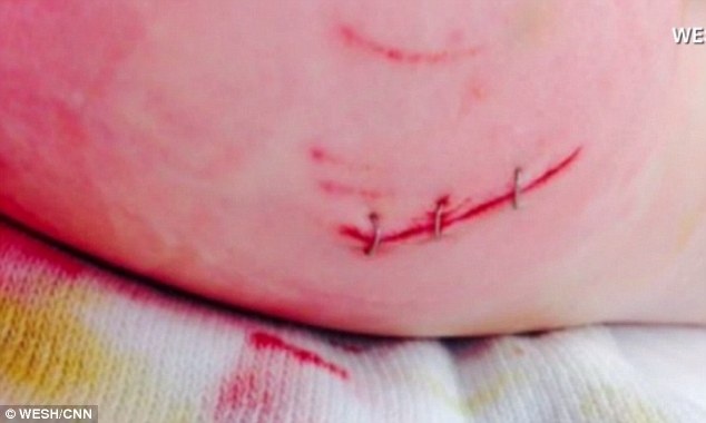 Một vết thương con cá sấu gây ra trên cơ thể James Barney. Ảnh: CNN