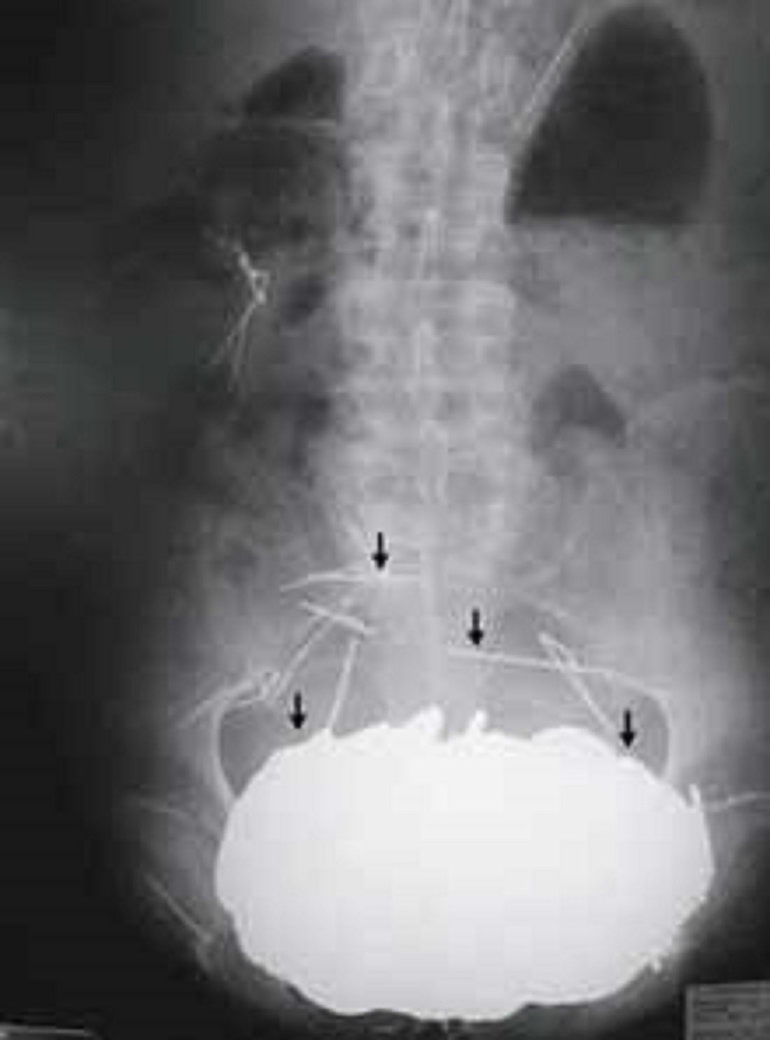 Các bác sĩ phát hiện gần 4,5 kg kim loại trong bụng một bệnh nhân ở Pháp. Ảnh: Chinadaily