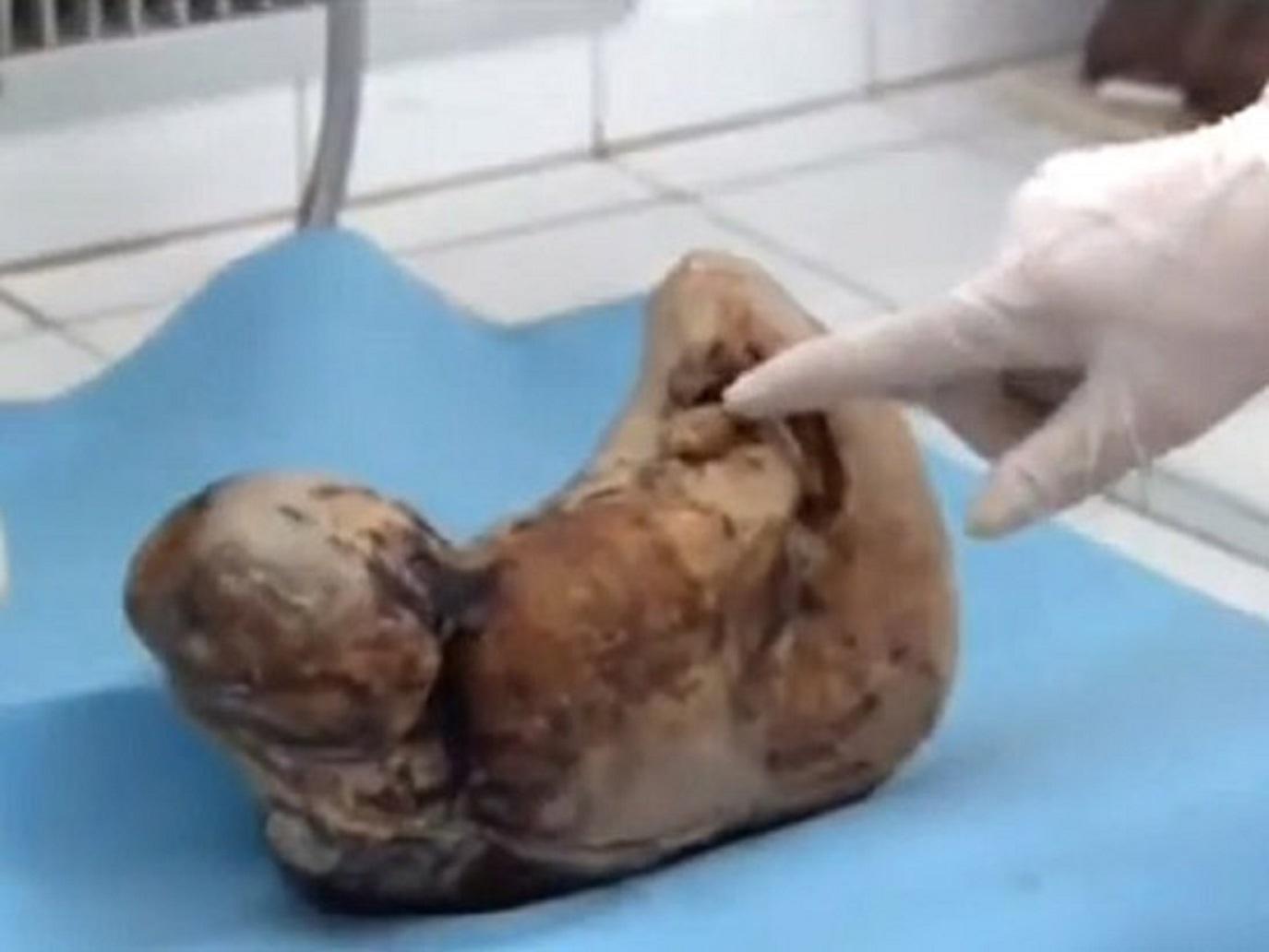 Thai nhi đá tồn tại 60 năm trong cơ thể một phụ nữ ở Trung Quốc. Ảnh: Remarkably